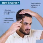 Derma Roller 1mm Stainless Steel – Skin Rejuvenation & Hair Growth Tool - Image 4